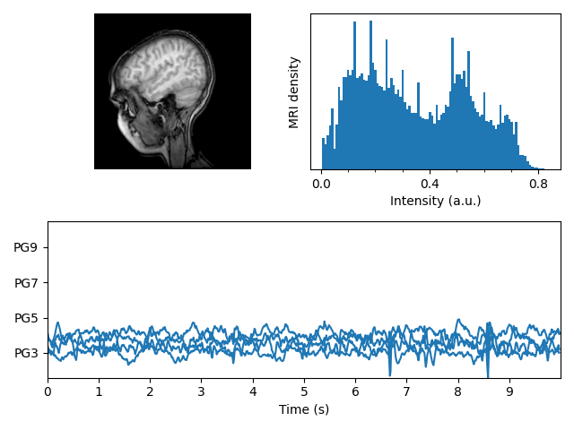 ressonância magnética com eeg